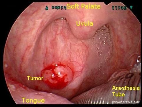 Cancers Besides lung cancer, tobacco use also increases the risk for cancers of the: Mouth Nose Sinuses larynx (voice box) pharynx (throat)