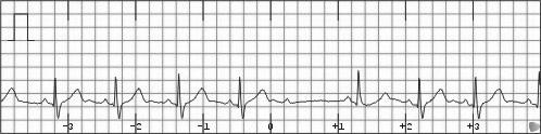 20 Narrow & Uniform Missing QRS after every other P wave (2:1
