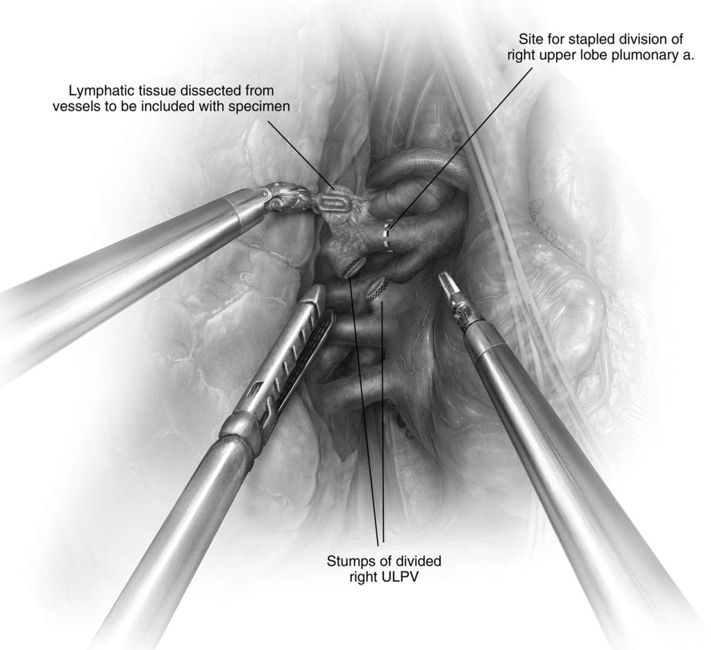 Robotic lobectomy 204.e14 Figure 11 Division of the right upper lobe pulmonary artery.