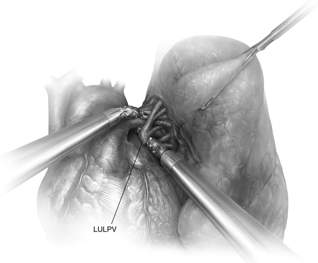 Robotic lobectomy 204.e20 Figure 17 Start of the left upper lobectomy. The superior pulmonary vein to the left upper lobe is identified and the adjacent nodal tissue is taken en bloc with it.