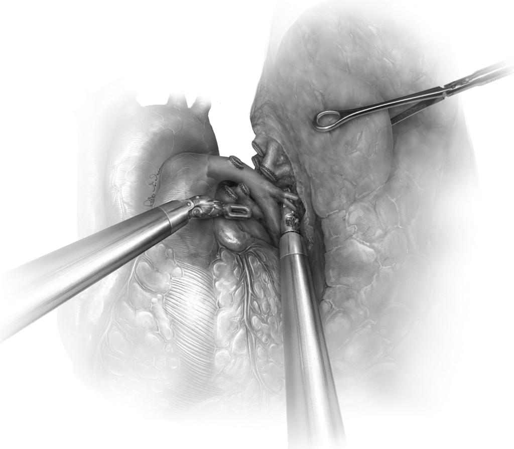 Robotic lobectomy 204.e22 Figure 19 Completion of hilar resection of the left upper lobe. The remaining arterial branches of the left upper lobe are taken with an 2.5-mm endostapler.