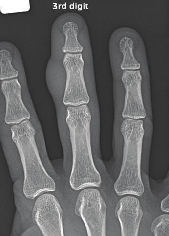 2 Case Reports in Orthopedics Figure 1: AP radiograph showing large fusiform soft tissue swelling of right middle finger at a level of the middle phalanx.