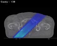understand interplay effects during TomoTherapy or VMAT 3: 3D Dosimetry in the
