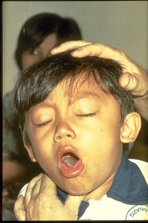 Symptoms of Pertussis Photo courtesy of WHO Initially: cold-like symptoms - runny nose, watery eyes, sneezing, fever and a