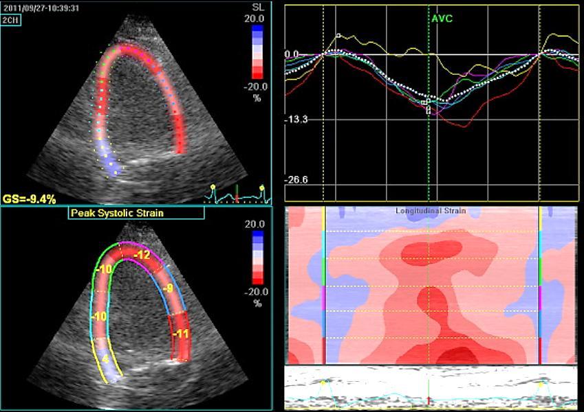 2D Speckle Tracking (our focus today) Myocardial deformation (fractional change in length of a myocardial segment) Unitless, expressed as a percentage Positive (lengthening) or negative (shortening)