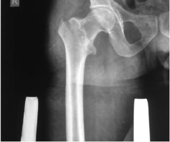 Trochanteric fracture femur treated with dynamic hip screw and proximal femoral nailing femoral head. The intramedullary nail was interlocked distally with one or 2 screws.