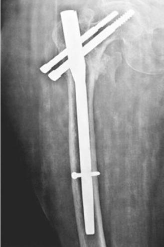 Keeping in view these things, this study was conducted to compare the results of PFN and DHS in extracapsular proximal femoral fractures.