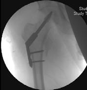 displacement Valgus osteotomy Anatomic +/- fixation