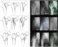 In March 2012, NYU School of Medicine institutional hospitals implemented a classification based treatment guide for IT hip fractures AO/OTA Intertrochanteric Fracture Classification SHS Short Nail