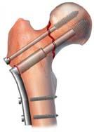 is the Best Internal Fixation Device? Frank A.
