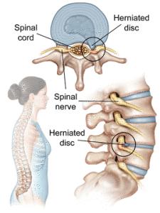 spinal column. The most common location for a herniated disc to occur is in the disc at the level between the fourth and fifth lumbar vertebrae in the low back.
