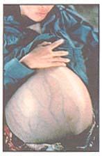 This woman is not pregnant! Hepatitis B This is a woman who has been infected with the Hepatitis B disease. This is a tumor on her liver that was caused by Hepatitis B damage to her liver.