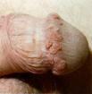 Genital Warts Caused by one of many strains of the Human Papilloma Virus (HPV) Highly infectious Genital warts are small projections of skin around the vaginal opening in women or on the penis or