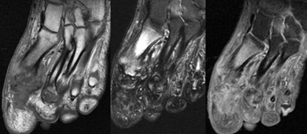 Fig.: Osteomyelitis at high pressure points: Coronal T1-w (left) and T2 fat-suppressed (right) images from the same patient as in the previous figure, showing loss of T1 signal with corresponding T2