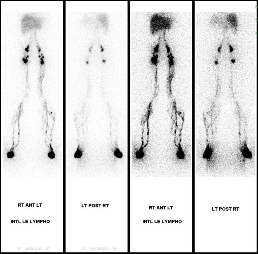 Fig. 2: Case 2-62 year old male with complaint of left lower extremity lymphedem for two years. Lymphoscintigraphy reveals dermal backflow and few ectatic lymphatic channels in the left calf.