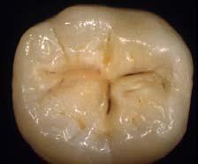 Caries Diagnosis and Treatment For the following questions (3 and 4): We are interested in your opinion on the following case: The patient is a 30-year old female with no relevant medical history.