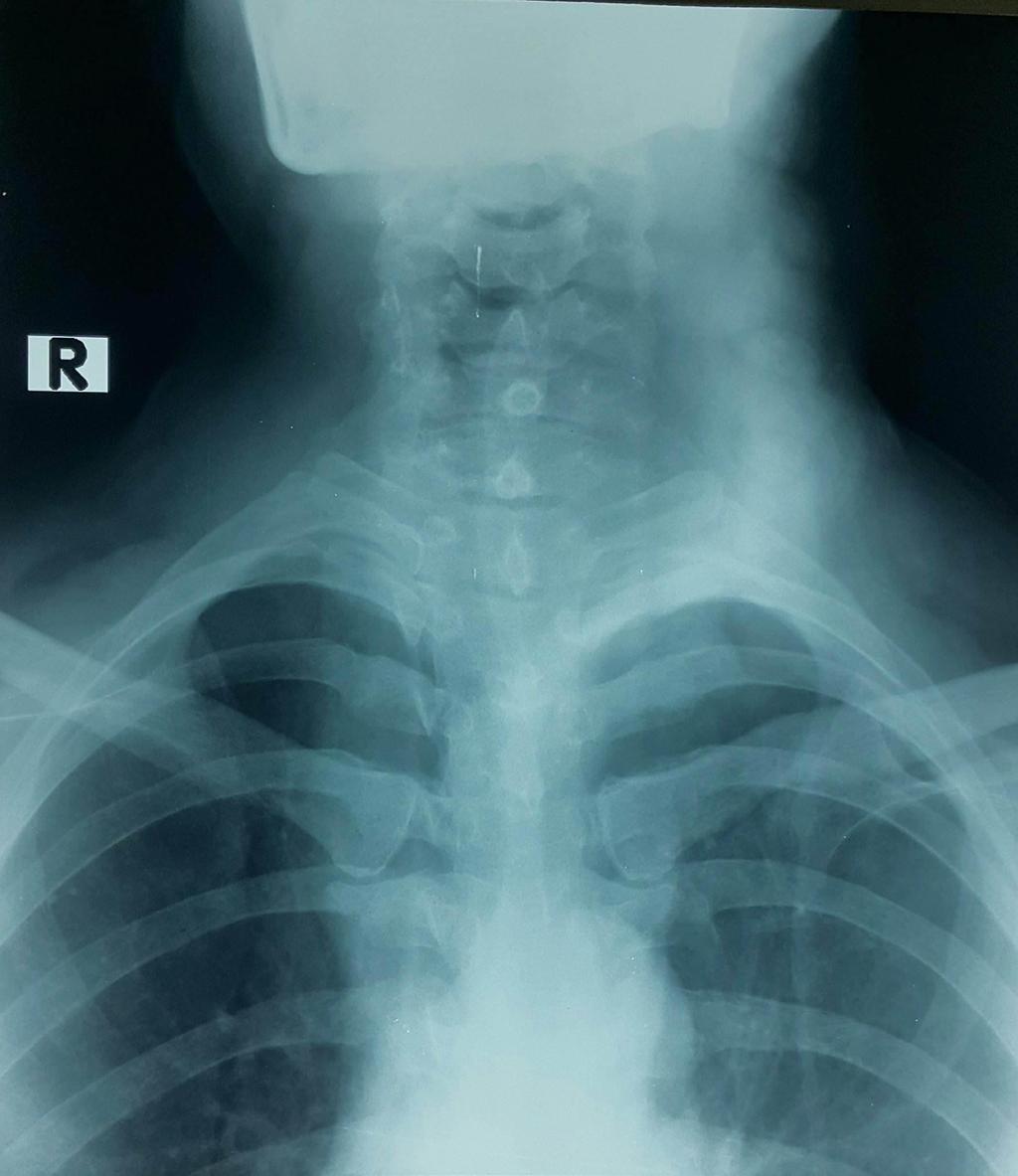 Chest Xray was ordered as shown in Figure 2.