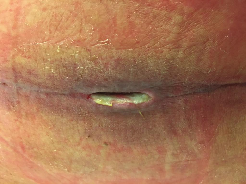 1 2 Wound dehiscence that was not caused by radiation.