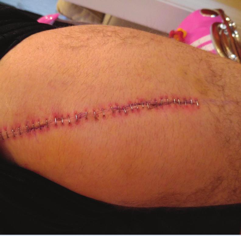 Beautifully healing thigh incision with staples intact two weeks