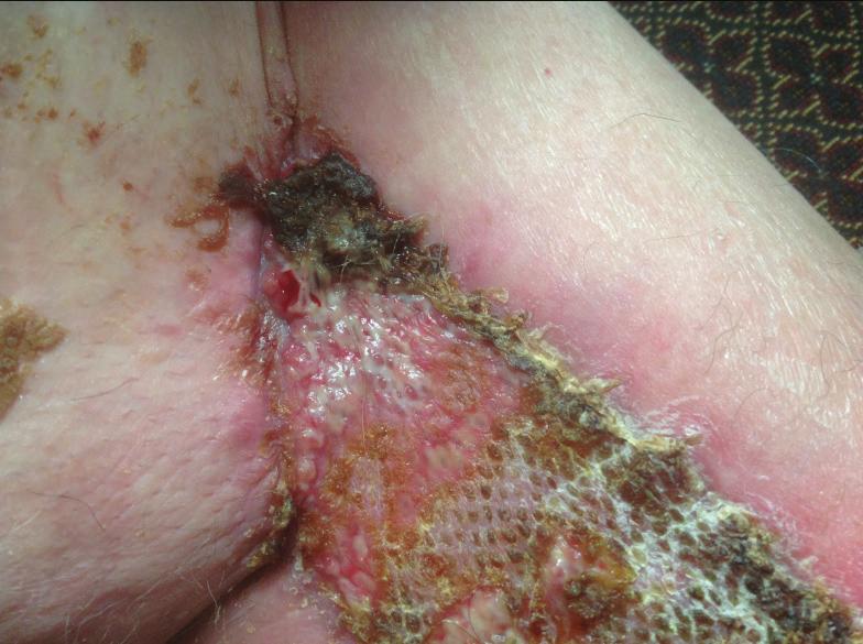 This is what a skin graft looks like. Location: upper thigh, close to the groin. The checkered/ fishnet pattern of the graft is normal.