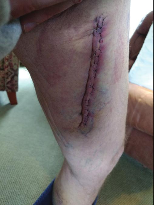 This is a healing incision after a soft tissue sarcoma resection.