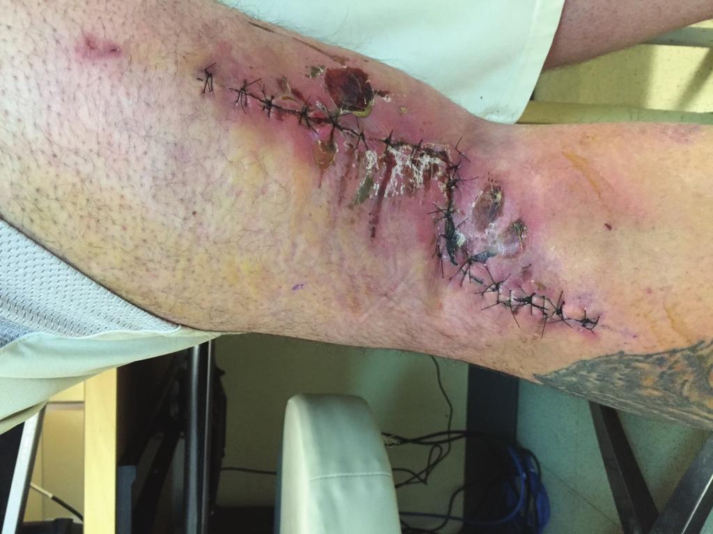 This is an incision after the excision of a benign soft tissue mass behind the knee.