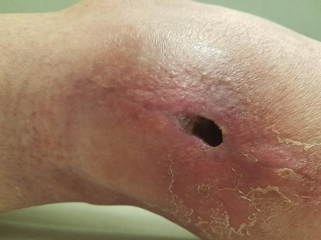 This shows delayed wound healing after the removal of a soft tissue sarcoma