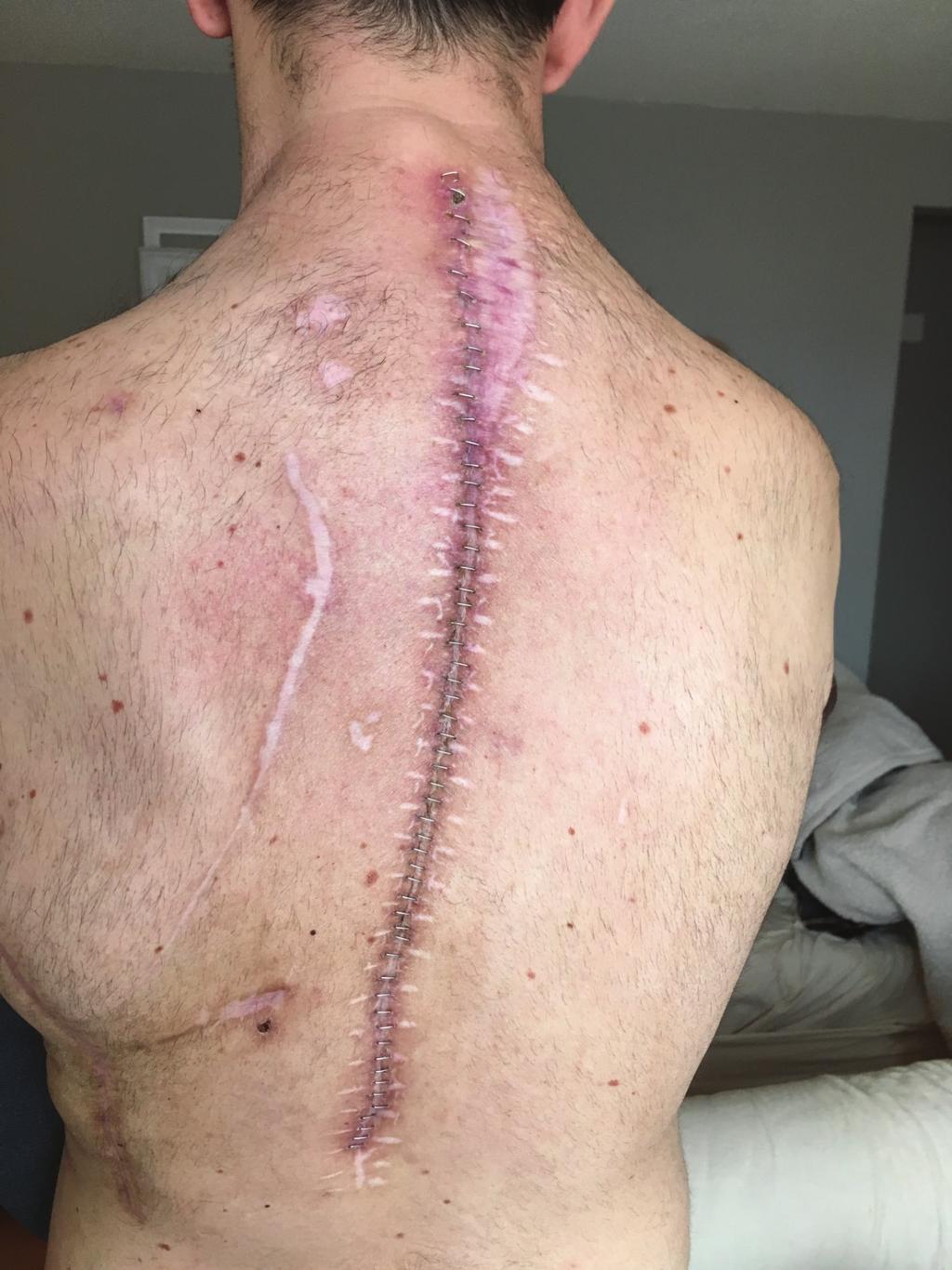 1 1. This is an incision that is healing well after radiation and