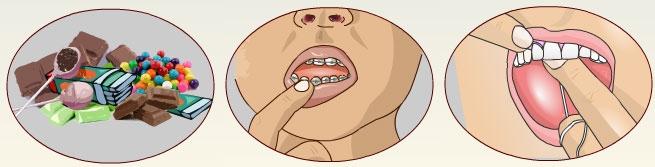 Begin flossing when all primary teeth are erupted. These measures help to prevent gum disease and dental decay. Night time bottle feeding should be avoided. Inspect your child s teeth regularly.