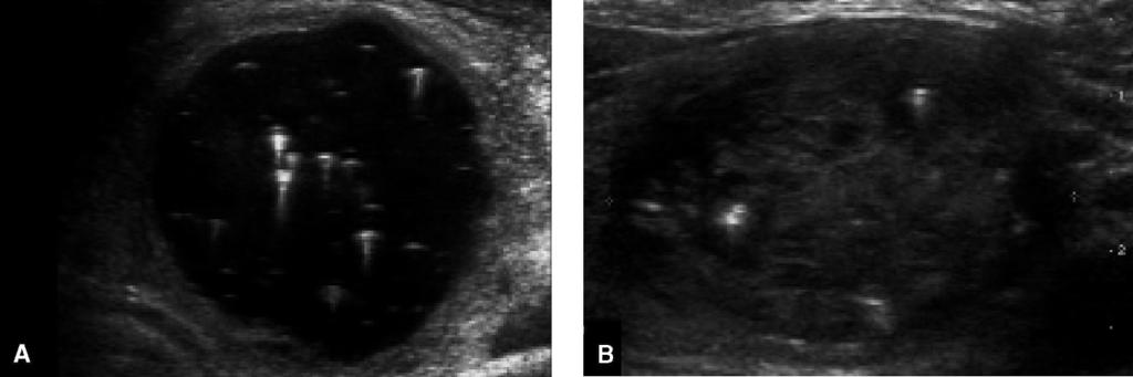 2 Ultrasound Features of Thyroid Lesions There are many different features indicating a certain benign or malignant tumor type, but many of these are overlapping signs.