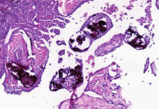 Calcified psammoma bodies will probably always be tiny, but granular amorphous deposits of calcium may vary in size. A, Papillary Thyroid Carcinoma. B, Follicular thyroid carcinoma.
