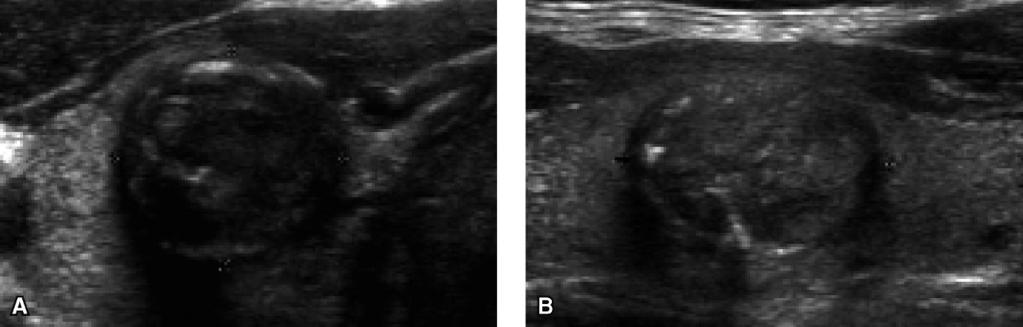 This pattern is less prominent in modern ultrasound equipment with cross beam technology. A, Colloid nodule. B, Papillary thyroid carcinoma. FIGURE 2 10.
