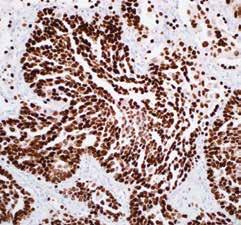 TTF-1 (EP229) Anti-TTF-1 (Thyroid Transcription Factor 1) is useful in differentiating primary adenocarcinoma of the lung from metastatic carcinomas originating in the organs rather than thyroid,
