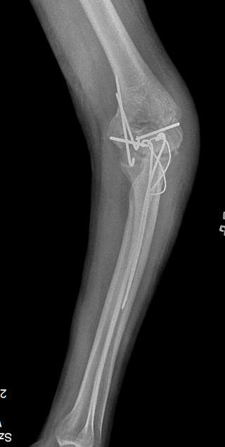 DISCUSSION Total elbow arthroplasty