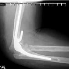 elbow arthroplasty with releasing 1/3 of