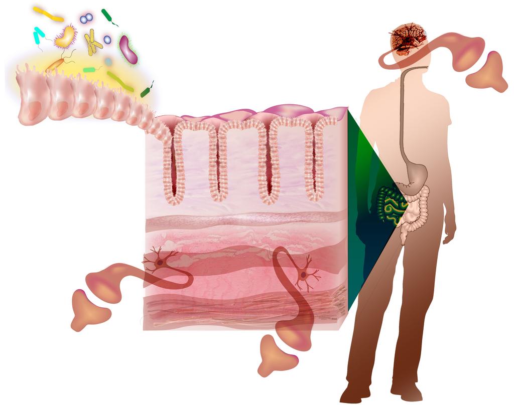 Overview of IBS Pathophysiology Host Factors Altered GI Motility Visceral hypersensitivity Altered brain-gut interactions Increased intestinal permeability Gut mucosal immune