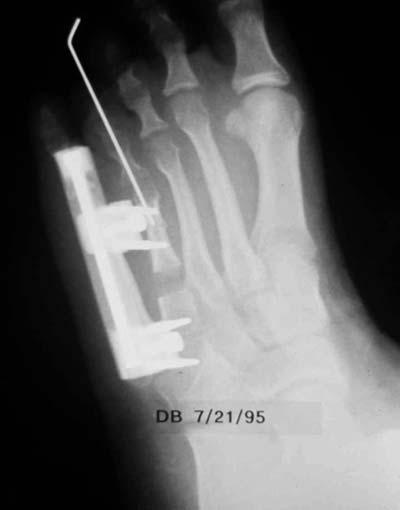 USE OF M 103 IN LENGTHENING OF A CONGENITALLY SHORT 4 th METATARSAL Insert a 2 mm diameter threaded wire (or 3 mm diameter bone screw) at 45 from the frontal plane and at right angles to the bone