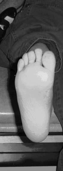 Soft tissue Perform the following: - Percutaneous tendo achilles lengthening - Abductor