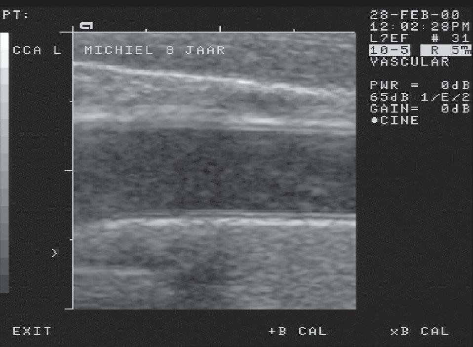 B-mode ultrasound arterial wall thickness measurements Figure 1a. Image and off-line image analysis of intima-media thickness (IMT) of the common carotid arterial far wall segment of an 8-year old.