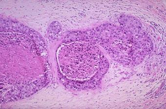 Carcinoma in situ Ductal carcinoma in situ 12-15% of malignant lesions in the Danish screening
