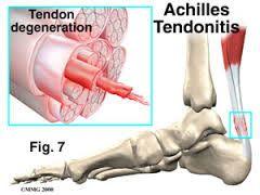 Achilles Tendonitis Burning aching in the heel TTP Pain with