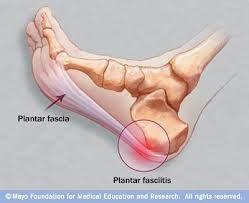 Plantar Fasciitis TTP at insertion Heel spur Pain worse in the morning or after