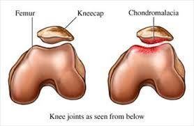 Patellofemoral syndrome chondromalacia patella Anterior knee