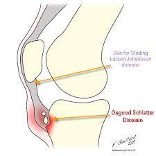 Osgood Schlatter Point of tenderness over the patella tendon