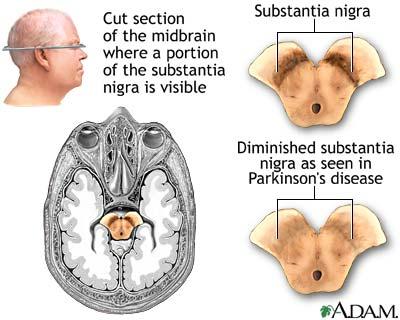 PARKINSON S DISEASE 38 Involves muscle rigidity, resting tremor, slow movements Parkinson s results