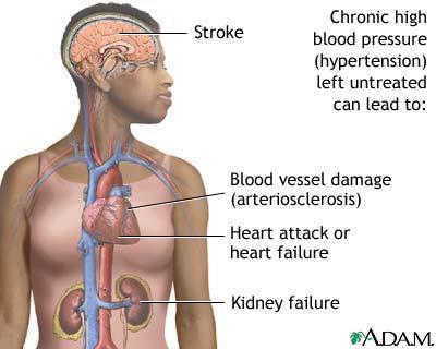 EFFECTS OF HYPERTENSION Untreated hypertension can result in
