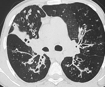 CTscan of the Chest Sinus disease Majority of patients Panopacification of paranasal sinuses in 90 to 100% of patients older than 8 months Chronic rhinosinusitis (forme fruste, heterozygote or