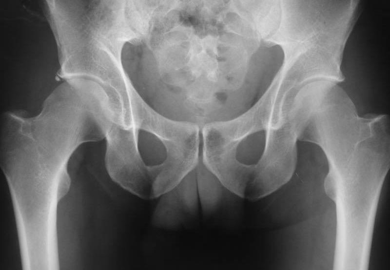 Pistol grip Femoro acetabular impingement Cam Type 90% of patients with so-called primary osteoarthritis, when adequately assessed, showed