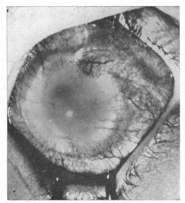 The sclera was bluish in the ciliary region. Ocular tension was felt to be within normal limits digitally (Schi0tz, 17-3/5-5 and 185/75 mm. Hg). The horizontal comeal diameter was 135 mm.