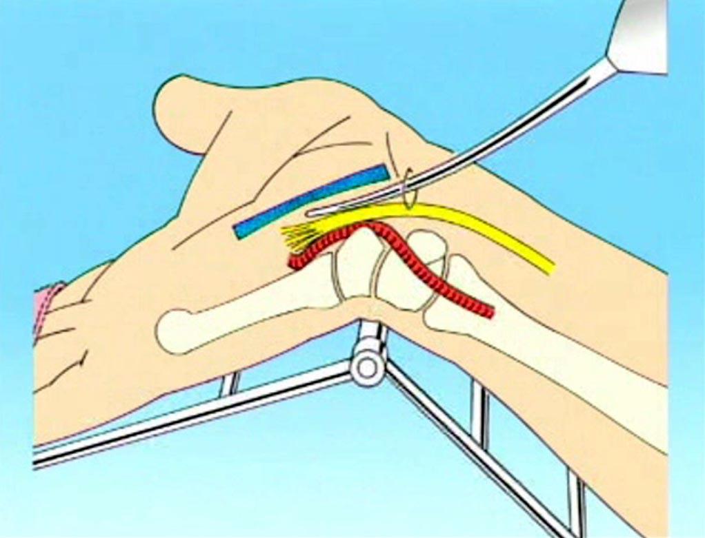 Chow Technique Enter the carpal tunnel - In line with axis of 4th finger - Just